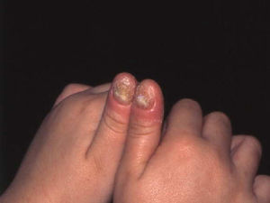 Onicomicosis y paroniquia candidiásica en paciente con candidiasis mucocutánea crónica.