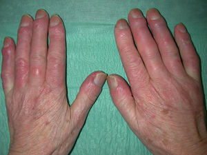 Marcado engrosamiento de los dedos en un paciente con esclerosis sistémica.