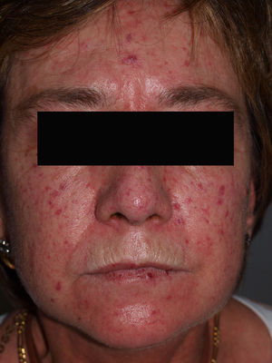 Telangiectasias faciales dispersas en la cara de una paciente con síndrome de calcinosis, Raynaud, esofagitis, esclerodactilia y telangiectasias.