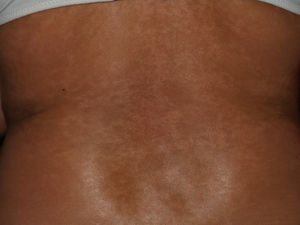 Lesiones hiperpigmentadas en la espalda de una paciente con esclerosis sistémica.