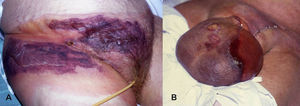 A) Fascitis necrotizante. Placa en abdomen e ingle, con amplias zonas equimóticas y ampollas flácidas serohemorrágicas. B) Gangrena de Fournier.
