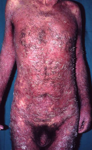 Eritrodermia psoriásica. Eritema y descamación generalizados.