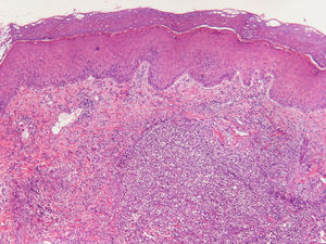 Biopsia cutánea de uno de nuestros casos (hematoxilina-eosina): la dermis se halla ocupada por un denso infiltrado inflamatorio de leucocitos polimorfonucleares neutrófilos. La epidermis aparece conservada.