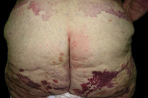 Vasculitis urticarial en una paciente con CM.