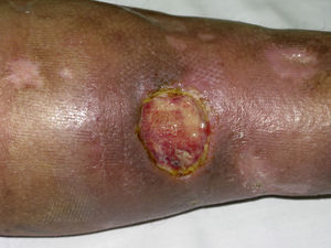 Úlceras cutáneas en una paciente con CM tipo II.