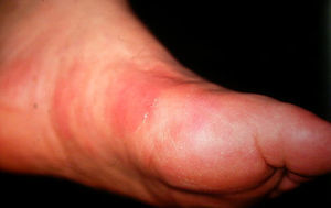 Tromboflebitis superficial migratoria que afecta a las venas del pie.