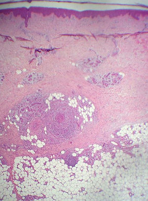 Inflamación de vena de gran tamaño localizada en el tejido celular subcutáneo superficial con escasa afectación del panículo adiposo.