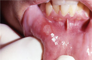 Las aftas orales pueden presentar un color blanco cremoso rodeado por un halo eritematoso.