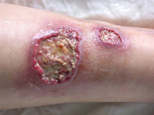 Durante su evolución, el pioderma gangrenoso forma úlceras profundas, necróticas y purulentas.