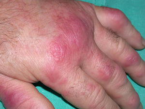 Síndrome de Sweet. Pápulas y placas eritematosas, edematosas y brillantes localizadas en dorso de mano. Las lesiones tienden a confluir y son dolorosas.