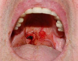 Erosiones en la cavidad oral en un paciente con pénfigo vulgar.