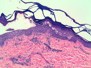 Biopsia de pénfigo foliáceo en la que se observa una ampolla a nivel de la capa granulosa.