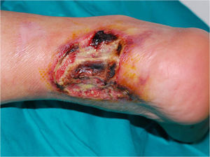 Pioderma gangrenoso ulcerativo en tercio inferior posterior de la extremidad inferior derecha, con exposición del tendón de Aquiles.