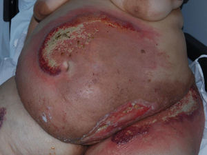 Pioderma gangrenoso con afectación de herida quirúrgica en zona inferior abdomen y amplias zonas ulceradas con márgenes inflamatorios en el resto del abdomen.