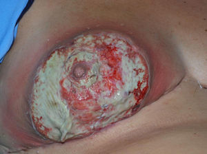 Pioderma gangrenoso de la mama en una paciente intervenida de neoplasia de mama.