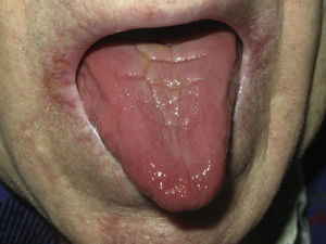 Estomatitis candidósica atrófica. Se observa una lengua eritematosa, brillante y depapilada.