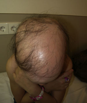 Placas confluentes de alopecia areata en el cuero cabelludo de un paciente con SPA-1.