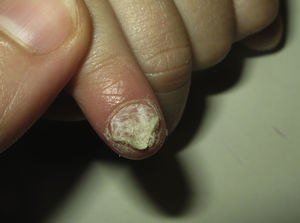 Distrofia ungueal en paciente con SPA-1. Cuando existan alteraciones ungueales, debe realizarse cultivo de las lesiones para descartar infección candidósica.