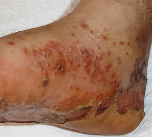 Queratodermia blenorrágica con afectación de la planta del pie izquierdo, con pústulas indistinguibles de las observadas en la psoriasis pustulosa.
