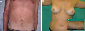 Lesiones de pitiriasis liquenoide y varioliforme aguda afectando al tronco y miembros superiores, antes del tratamiento, en los casos 1 (A) y 2 (B). (C) Detalle de las lesiones en miembro superior en el caso 2.