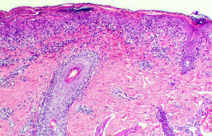 Infiltrado superficial de predominio linfocítico y distribución perivascular e intersticial, así como dermatitis de la interfase con degeneración vacuolar de la hilera basal y presencia de abundantes linfocitos y algún queratinocito necrótico en la epidermis (hematoxilina-eosina, 100×).