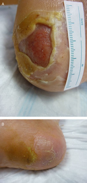 Paciente 1. A) Lesión en talón de paciente diabético, previa al tratamiento. B) Aspecto de la lesión curada a los 3 meses.