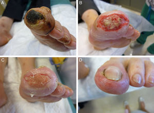Paciente 1. A) Lesión necrótica distal previa al tratamiento. B) Al mes de tratamiento. C) Se observa la aparición de tejido de granulación. D) Curación de la lesión a los 2 meses del tratamiento.