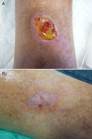 Paciente 2. A) Úlcera pretibial durante el primer tratamiento, en la que se aprecia el suero plaquetario. B) Curación de la lesión al mes.