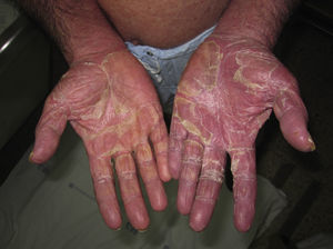 Descamación laminar palmar en varón con eritrodermia psoriásica.