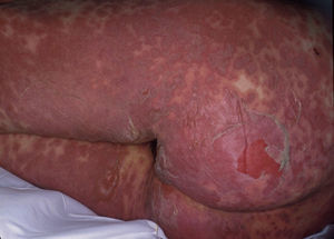 Exantema eritematovioláceo y despegamiento epidérmico en paciente con necrólisis epidérmica tóxica.