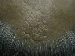 Múltiples pápulas normocoloreadas confluyentes en la región occipital del cuero cabelludo.