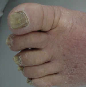 Xantoniquia e hiperqueratosis en un paciente con onicomicosis.
