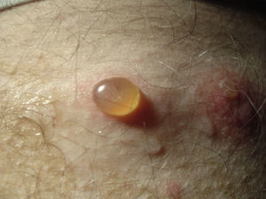 Lesiones ampollares en un paciente con penfigoide bulloso.