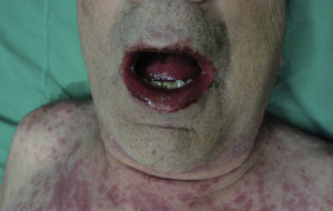 Paciente con síndrome de Stevens-Johnson. Observe el compromiso de mucosas.