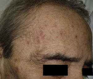 Paciente con múltiples queratosis actínicas en la frente.