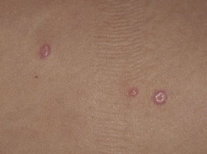 Pápulas umbilicadas agrupadas en un caso de infección por el virus del molusco contagioso.