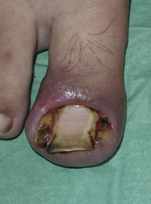 Granulomas a cuerpo extraño en ambos pliegues periungueales laterales del primer dedo del pie secundarios a onicocriptosis.