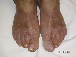 Eritema, descamación e hiperpigmentación en dorso de los pies secundarios al uso de sandalias de goma.