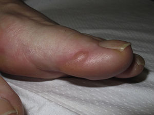 Ampolla en la cara externa del primer dedo del pie aparecida tras una larga marcha y secundaria al roce continuado.