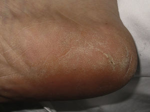 Hiperqueratosis difusa en el talón secundaria al uso de calzado deportivo inapropiado.