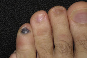 Hematoma subungueal en cuarto dedo del pie tras una excursión de 50km.