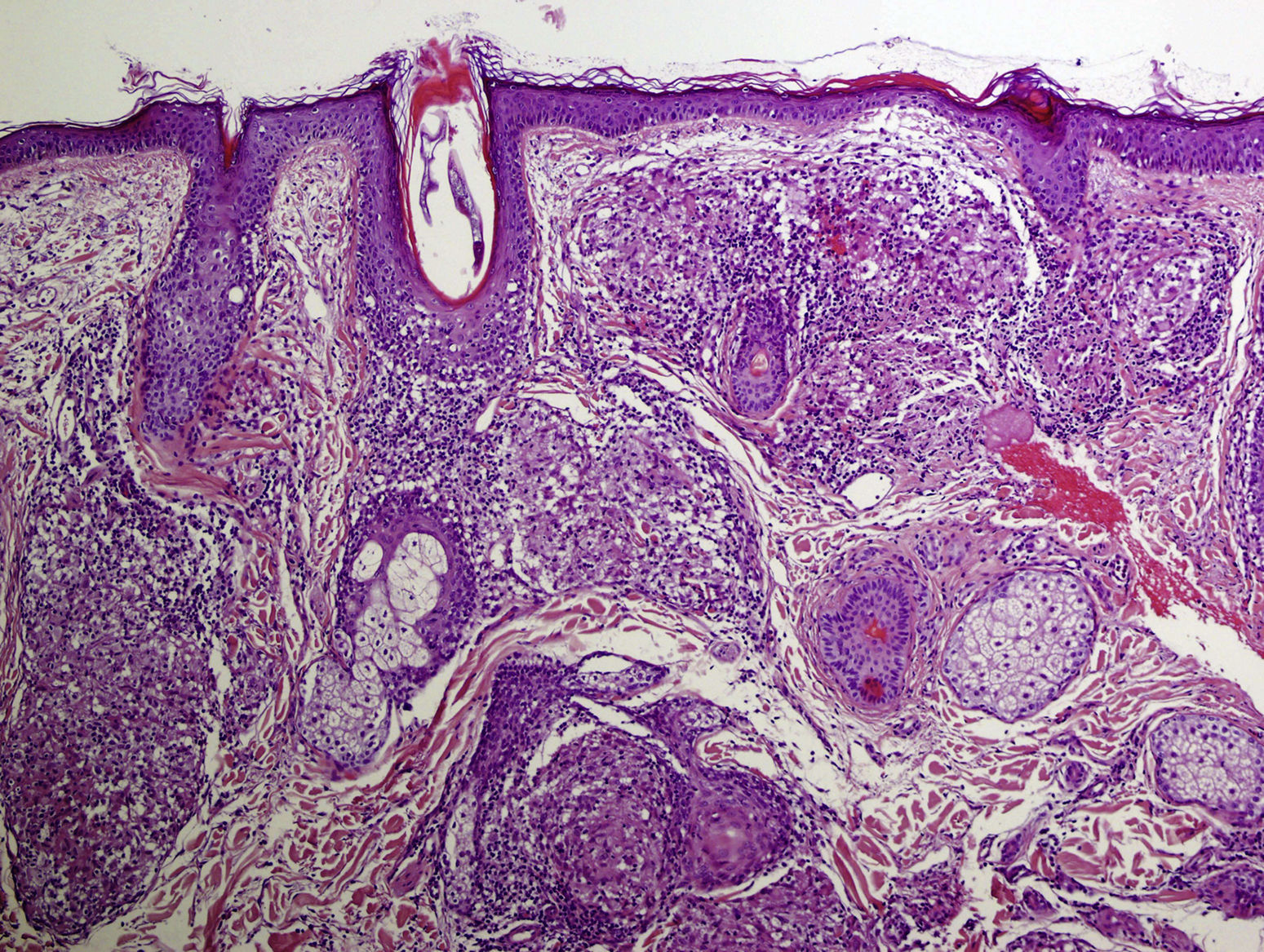Placa eritematosa facial con múltiples telangiectasias en superficie ...