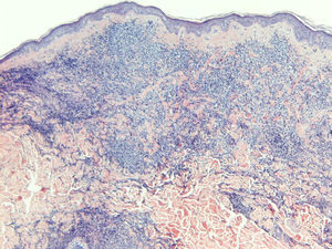 Infiltrado denso dérmico por células de talla media y citoplasma mal definido (hematoxilina-eosina, ×40).