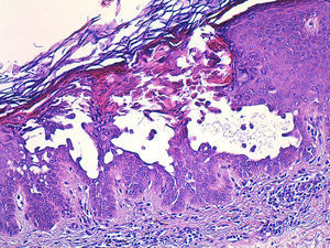 Hiperplasia epidérmica con foco de acantólisis y disqueratosis; además la dermis presenta un discreto infiltrado inflamatorio (hematoxilina-eosina ×10).