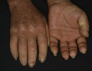 Manos de un paciente con esclerosis sistémica cutánea limitada y anticuerpos anticentrómero. Nótese la desaparición de las líneas de la piel en la cara dorsal y la ausencia de anejos debido a la fibrosis. En la cara palmar se observan telangiectasias, úlceras puntiformes en los pulpejos de los dedos, amputaciones distales y pterigium ungueal inverso.
