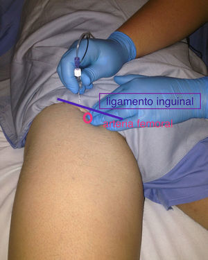 Bloqueo femoral. Se dirige la aguja con un ángulo de 60° inmediatamente por debajo del ligamento inguinal, a 1cm o 1,5cm lateral a la arteria femoral2.