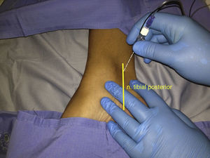 Bloqueo del nervio tibial: inserción de la aguja por debajo y detrás del maléolo medial.