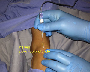Bloqueo del nervio peroneo profundo: inserción de la aguja lateral a la arteria dorsal del pie y el tendón del músculo extensor largo del pulgar.