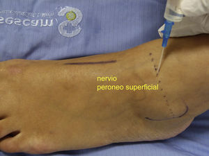 Bloqueo del nervio peroneo superficial: infiltración por encima del maléolo lateral desde el punto medio y anterior de la pierna hasta la cara lateral en la región del maléolo.