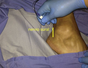Bloqueo nervio sural: inserción de la aguja en el punto medio entre el maléolo lateral y tendón de Aquiles.